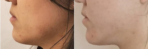Before 13 Front