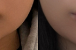  입술필러 레스틸렌1cc 전후사진