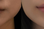  입술필러 레스틸렌1cc 전후사진