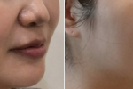  울쎄라프라임600샷 전후사진
