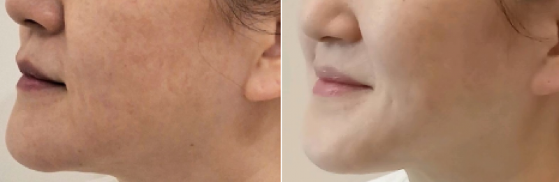 울쎄라프라임600샷